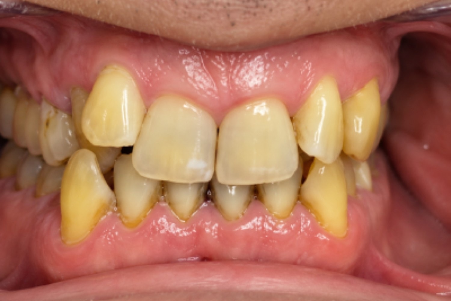 Multidisciplinary Dentistry Before & After