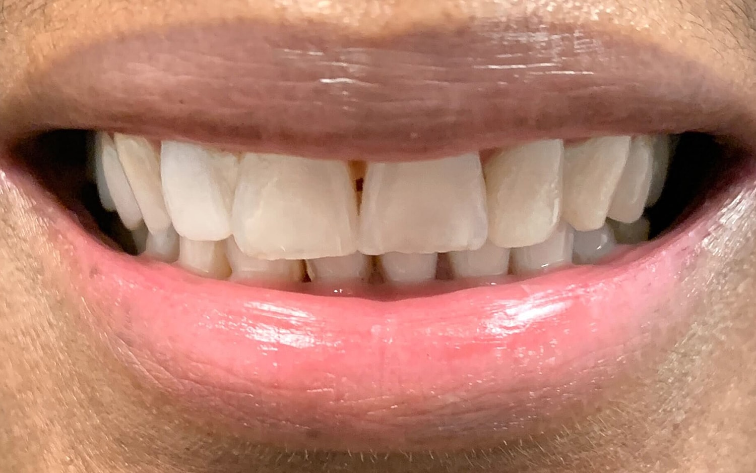 Multidisciplinary Dentistry Before & After