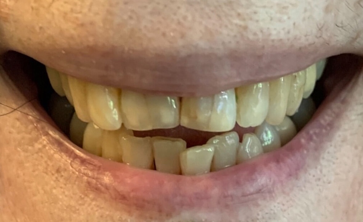 Multidisciplinary Dentistry Before & After