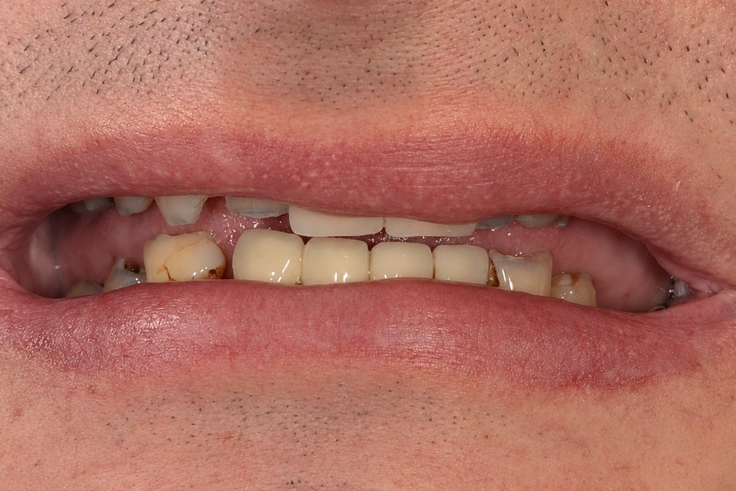 Full Mouth Reconstruction Before & After