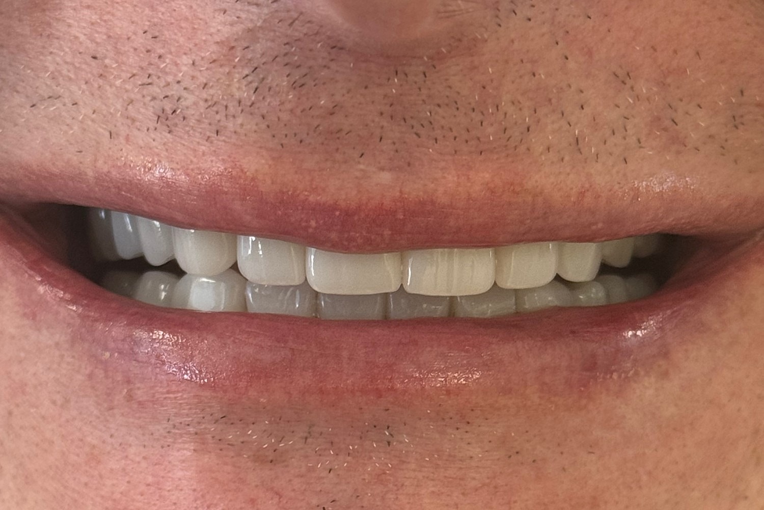 Full Mouth Reconstruction Before & After
