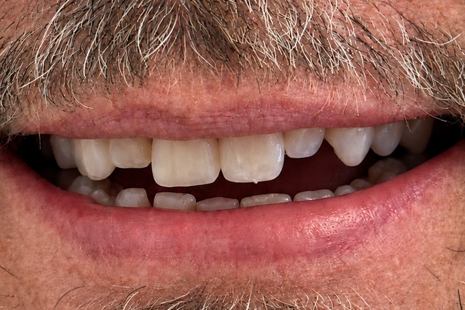 Dental Veneers Before & After