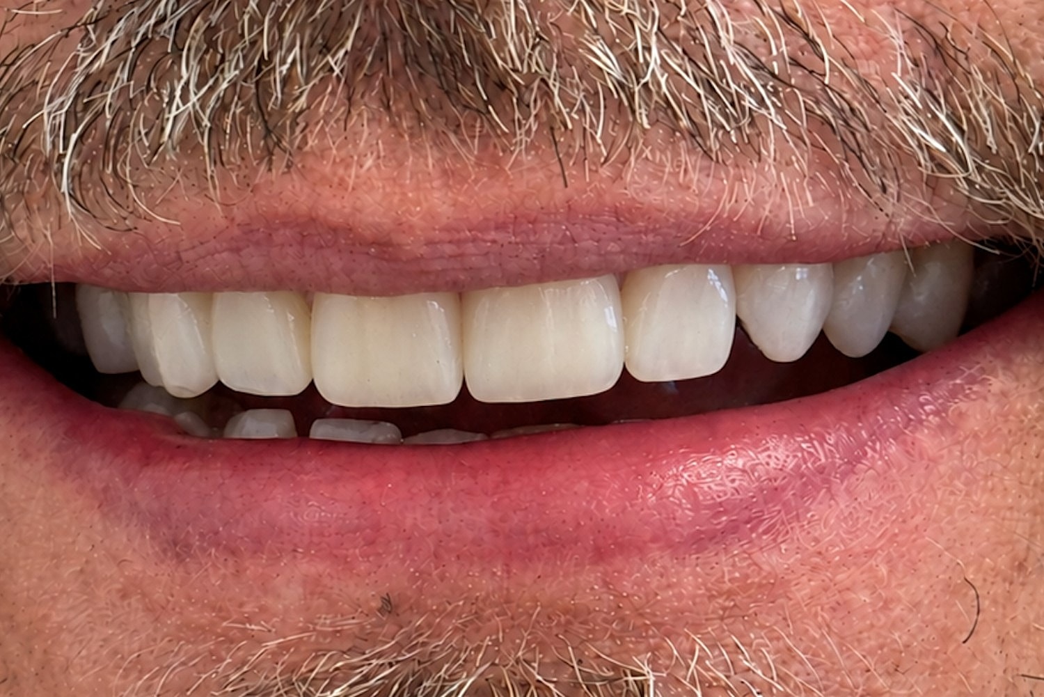 Dental Veneers Before & After