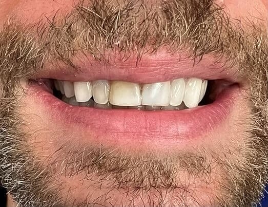 Smile Makeover  Before & After