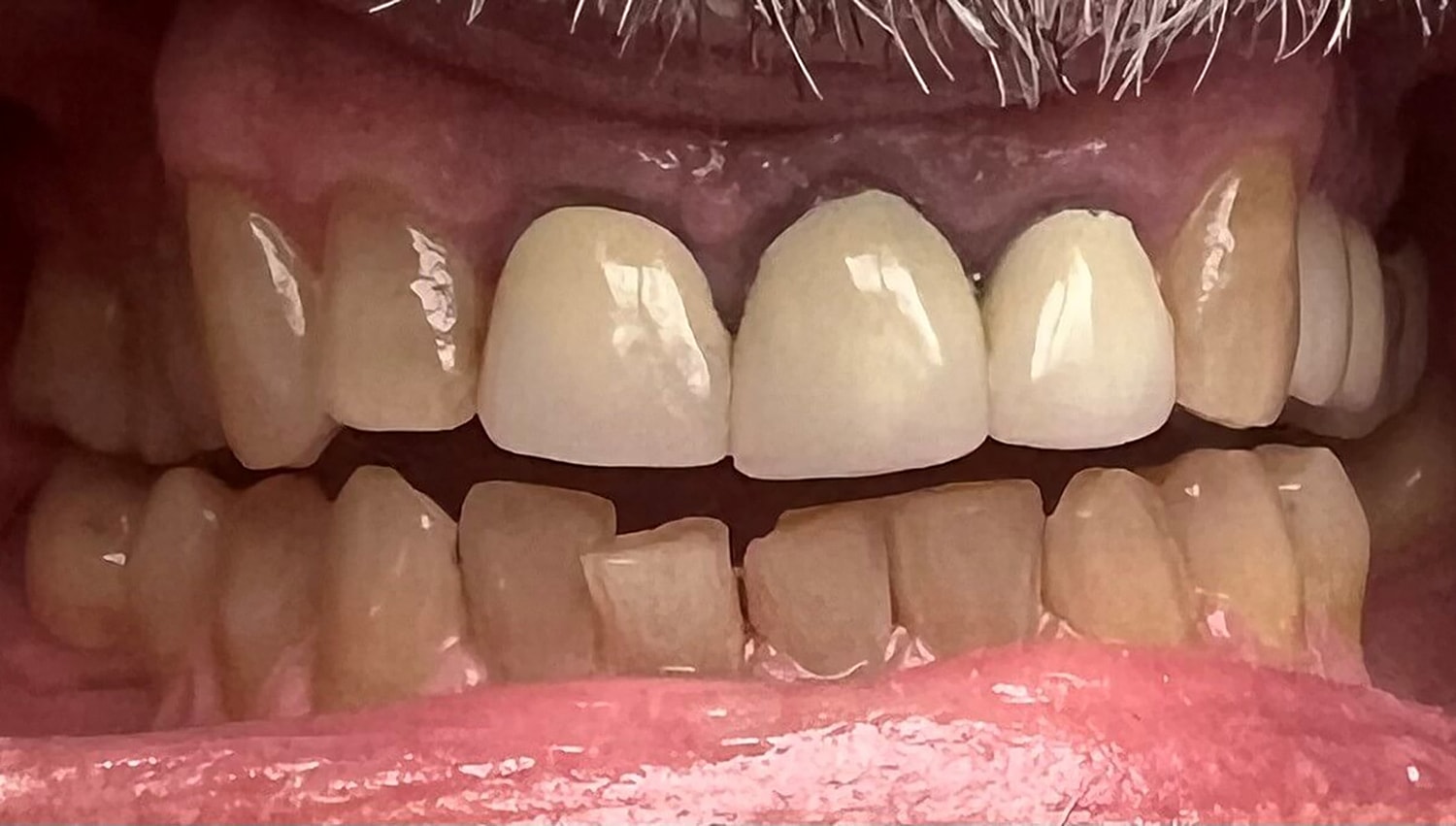 Dental Crowns Before & After