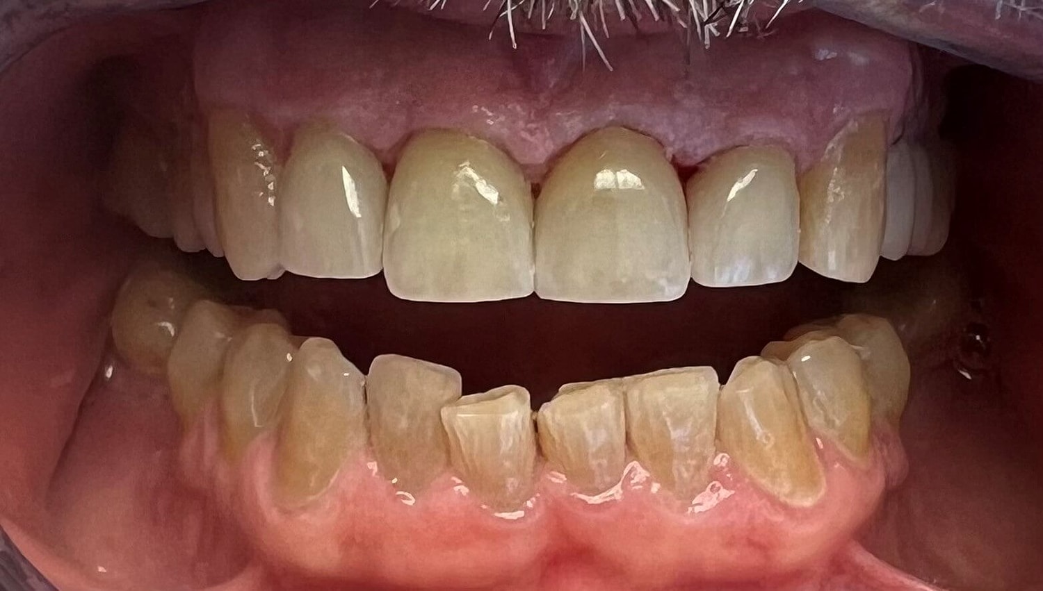 Dental Crowns Before & After